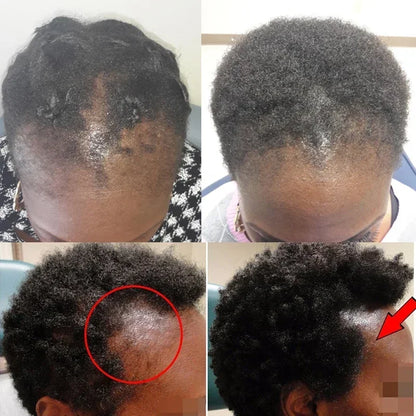 99% of buyers buy again, have more and more hair, say goodbye to baldness, thick hair,Hot selling product